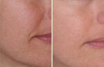 Meach Mask | Led Light Therapy Mask for Skin Rejuenation - Image 6