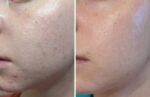 Meach Mask | Led Light Therapy Mask for Skin Rejuenation - Image 8
